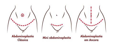 Abdominoplastia Cirurgia Plástica Transplante Capilar Cirurgião