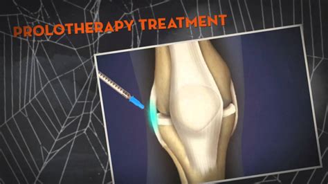 Prolotherapy Treatment Chronic Knee Pain Tampa Pain Physicians 813 961 1314 Youtube