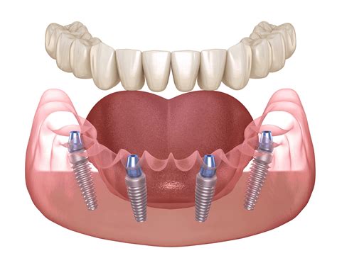 Implantologia Transmucosa Senza Tagli E Punti Di Sutura Impianti