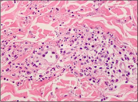 Leukocytoclastic Vasculitis Histology