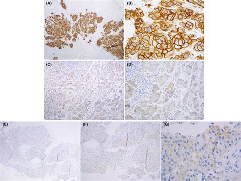 Her2 Evaluation For Clinical Decision Making In Human Solid Tumours