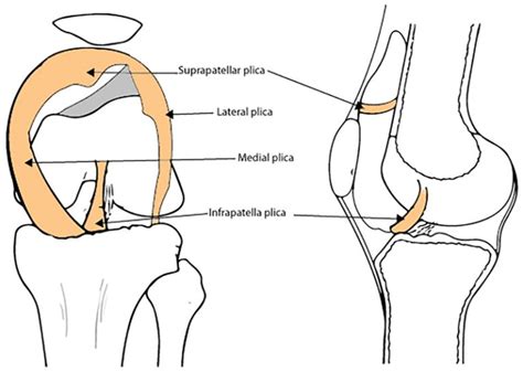 Plica Knee Condition David Slattery