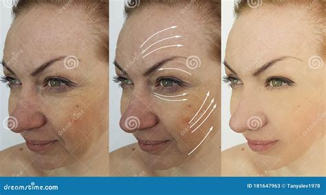 Wrinkle Eye Wrinkles before and after Treatment Stock Image - Image of circle, cosmetic: 181647963