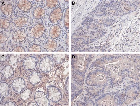 Representative Expression Of Pax1 And Sox1 Protein In Colorectal