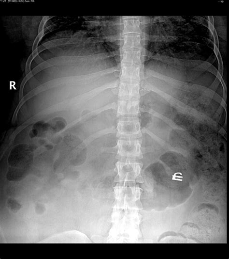 Abdomen X Ray Positioning