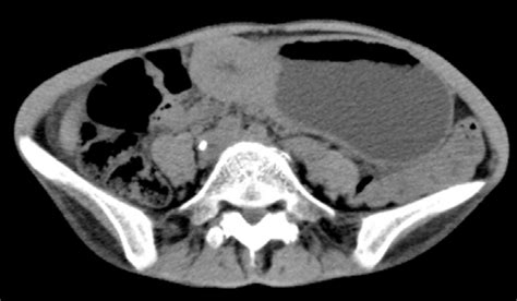 Abdominal Ct Revealing Wall Thickening Of The Antrum Of Stomach No Download Scientific Diagram