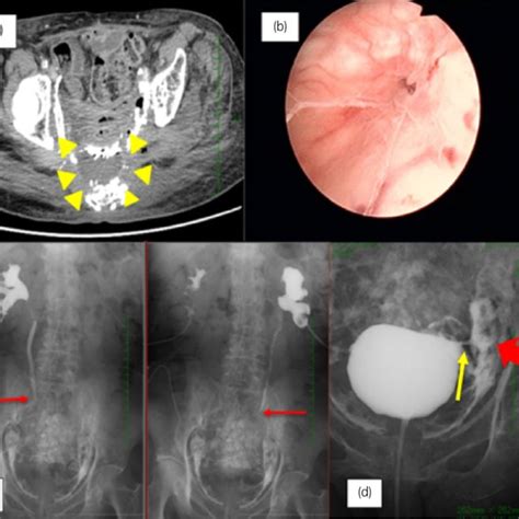 Pdf Refractory Fistula Of Bladder Repaired With Transurethral