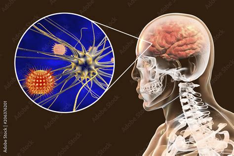 Meningitis Brain Infection