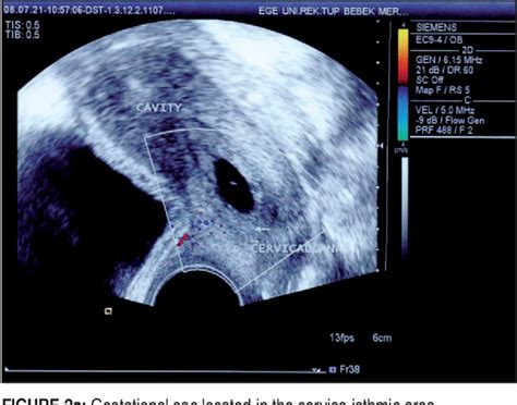 Figure 2 From Cervical Ectopic Pregnancy Of 45 Xo Embryo After In Vitro