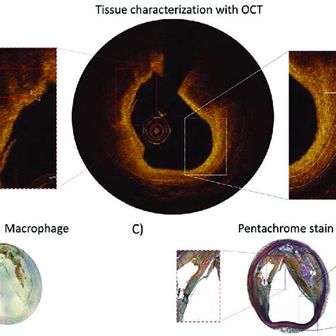 A Tissue Characterization With OCT Demonstrating Pathological