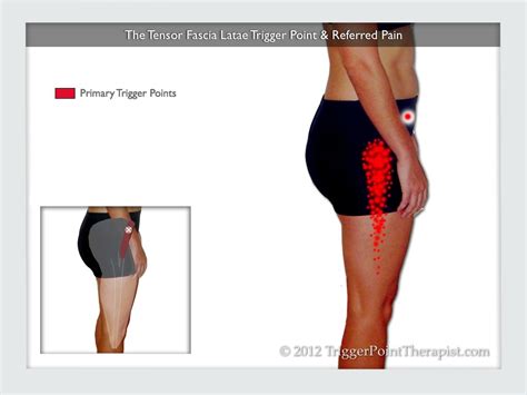 Tensor Fascia Lata Trigger Point In It Band And Hip Pain Complaints