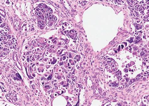 Figure 4 [wilms Tumour With Anaplasia ] Wilms Tumor Ncbi Bookshelf