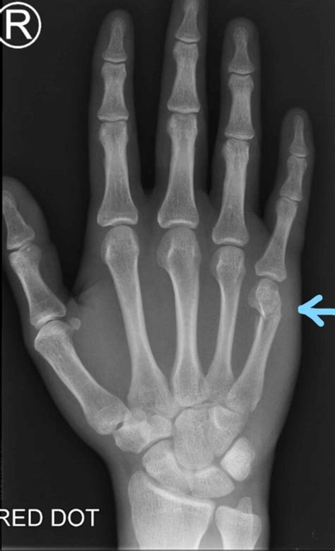 Boxer’s Fracture - Motus Physical Therapy