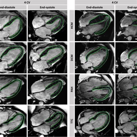 Cardiac Magnetic Resonance Feature Tracking In Different Diseases Download Scientific Diagram