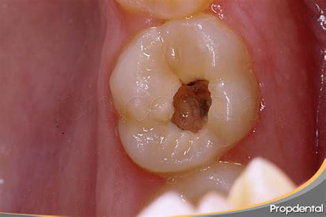 Caso Clínico Del Tratamiento De Endodoncia En Propdental