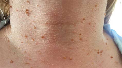 Skin Tags Groin