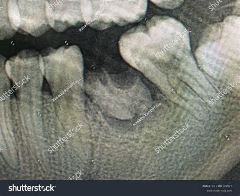 Dental Periapical X Ray Images Stock Photos Vectors Shutterstock