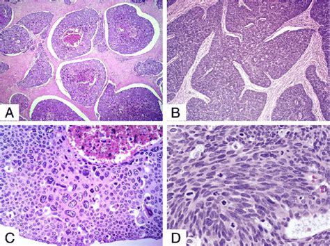 Classic Basaloid Squamous Cell Carcinoma A Small Basaloid Cells