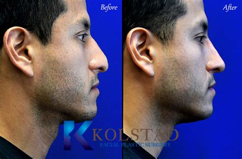 Nose Job Before And After Men