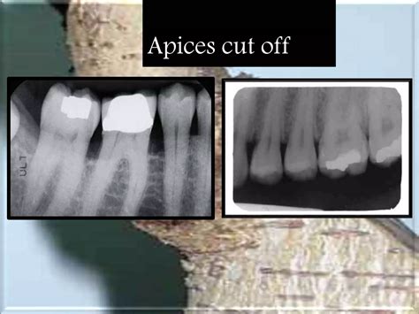 Artifact And Errors In Intraoral Periapical Radiograph Ppt