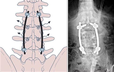 The Rods Were Assembled To The Pedicular Screws In A Lateral Bent Form