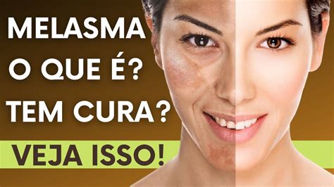 O que é MELASMA Qual é o melhor TRATAMENTO PARA MELASMA Isso Clareia