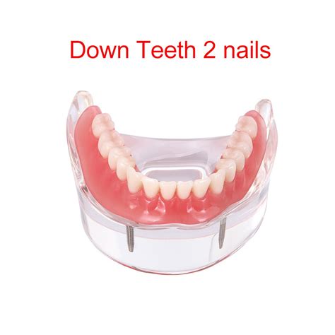 Dental Overdenture Teeth Dental Implant Teeth Mode Grandado