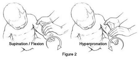 Nursemaids Elbow Reduction WikiSM Sports Medicine Wiki