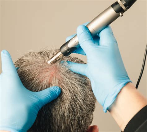 Mesotherapy Hair Loss Eden Medispa Award Winning Aesthetic Clinic