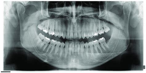 Panoramic Radiography Carried Out Perfectly The Dark Space Between The