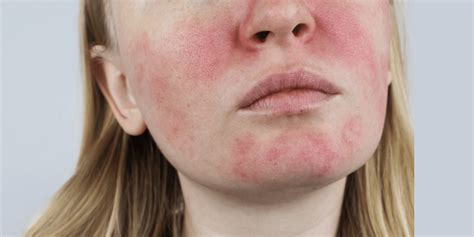 The Best Rosacea Treatments Red Skin City Skin Clinic