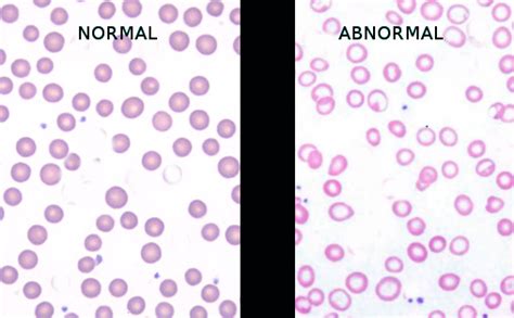 [figure Iron Deficiency Anemia Image Courtesy S Bhimji Md