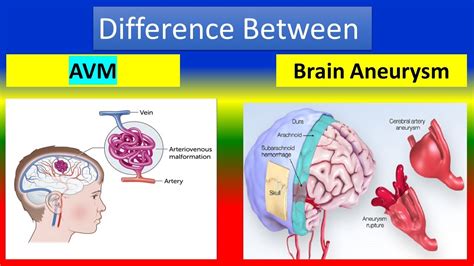 Difference Between AVM And Brain Aneurysm YouTube