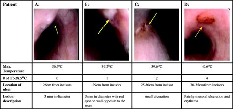 Esophageal Injury And Temperature Monitoring During Atrial Fibrillation