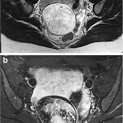 MRI Of Mature Cystic Teratoma In A 16 Year Old Girl A Coronal Oblique