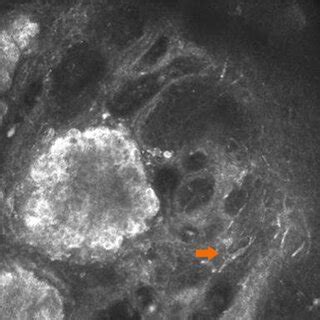 Langerhans cells around the lesions. Thick Langerhans cells (orange... | Download Scientific Diagram