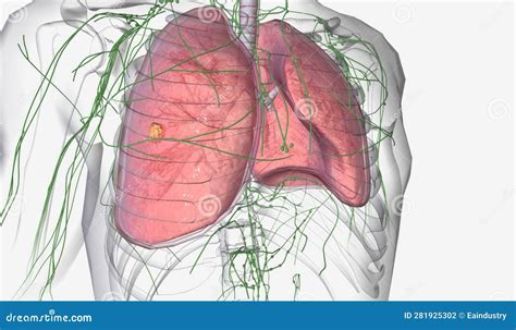 Lung Cancer Stage I stock illustration. Illustration of system - 281925302