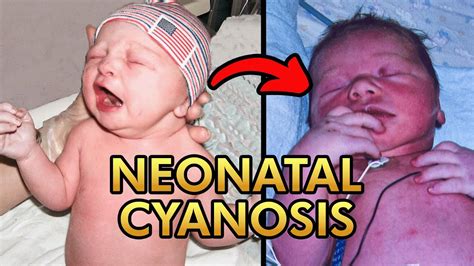 Neonatal Cyanosis Pathophysiology Types Differential Diagnosis And