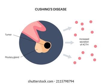 Cushing Syndrome Disease Medical Poster Pituitary Stock Vector (Royalty ...