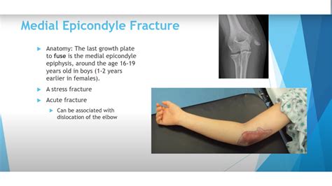 Paediatric Upper Extremity Trauma —