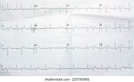 27 Ekg Nsr Images, Stock Photos & Vectors | Shutterstock