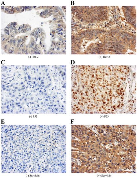 SUVmax Of 18F FDG PET CT Correlates To Expression Of Major Chemotherapy