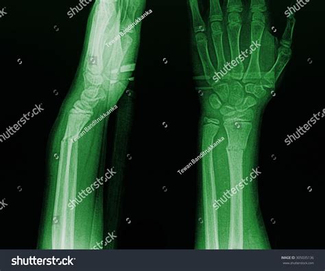 Film Xray Wrist Show Fracture Distal Shutterstock