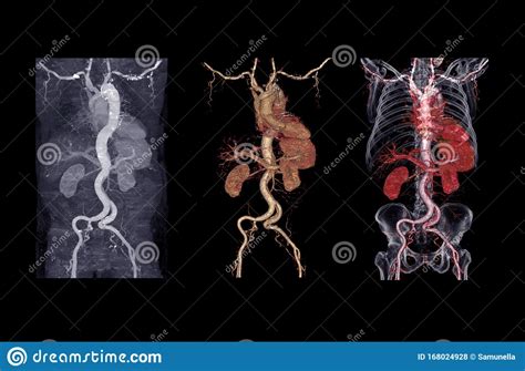 Photo Du Rendu De L Aorte Abdominale En 3d De Ltc Montrant La