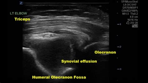 Olecranon Fossa