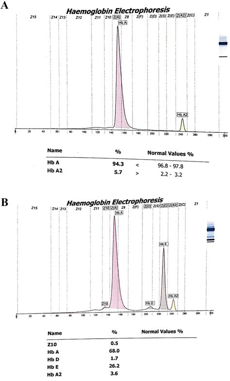 Figure 1 From Challenge In Diagnosis Of Hemoglobin Ebeta Thalassemia During Pregnancy A Case