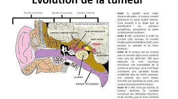 O Se Faire Op Rer D Un Neurinome