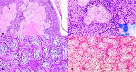 2a: HPE of lymph node showing effaced architecture and caseous necrosis ...