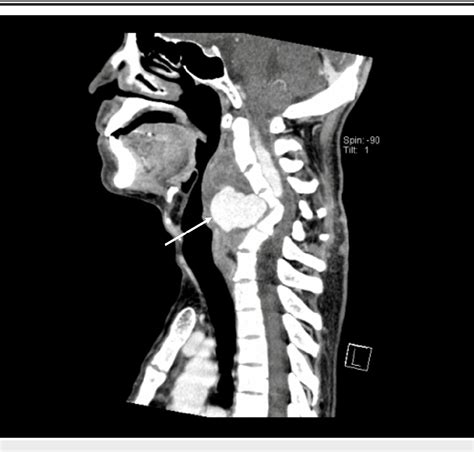 Figure 2 from Reverse Cervical Lordosis Caused by Giant Vertebral ...