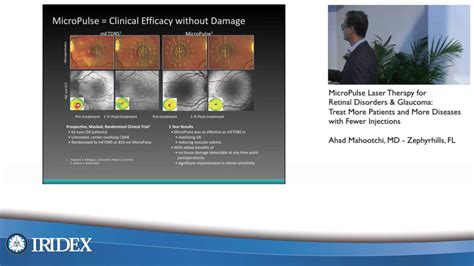 Micropulse Laser Therapy For Retinal Disorders And Glaucoma Youtube